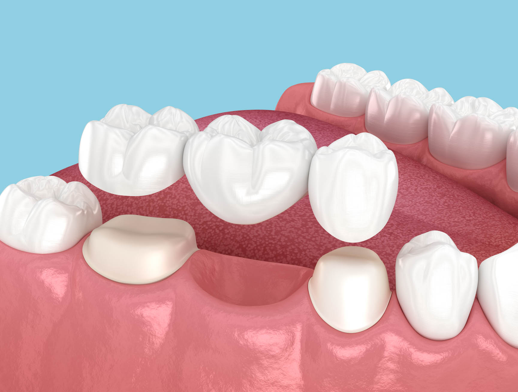 Dental bridge illustration