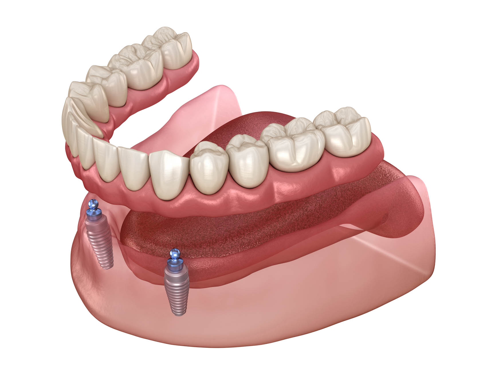 Implant-supported denture illustration