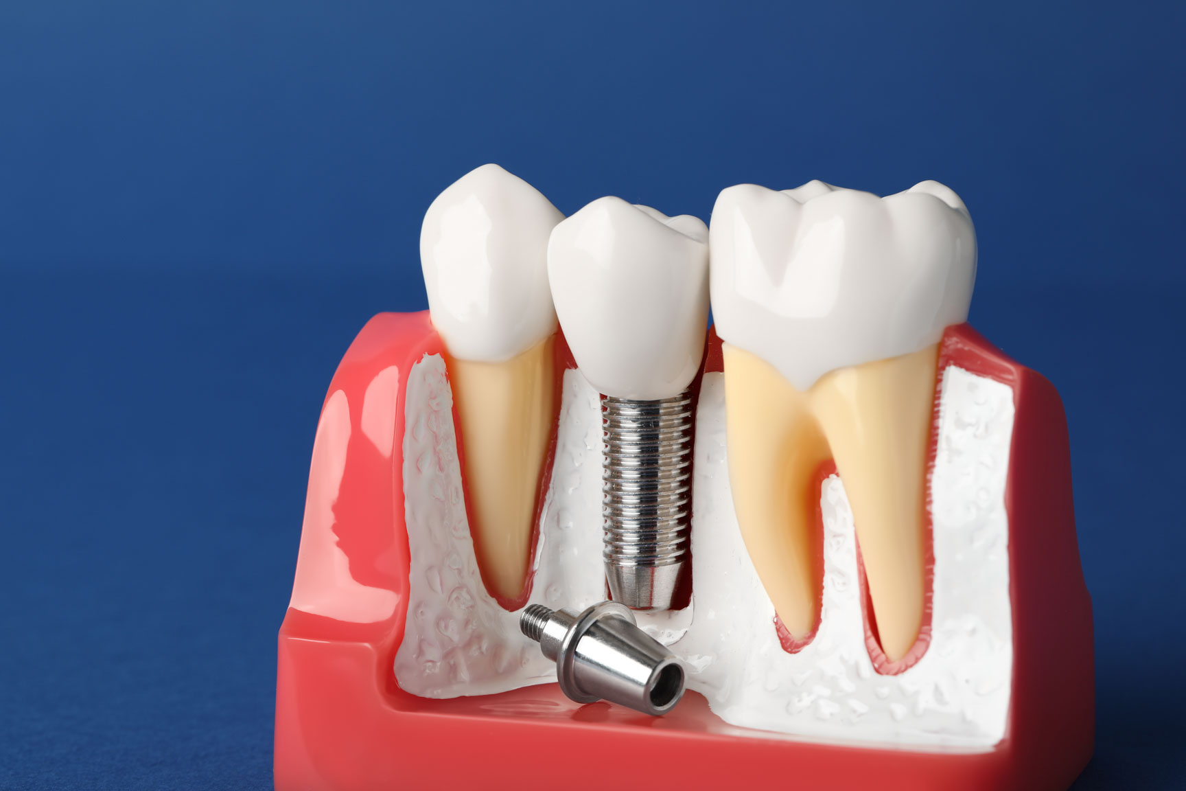 Dental implant illustration
