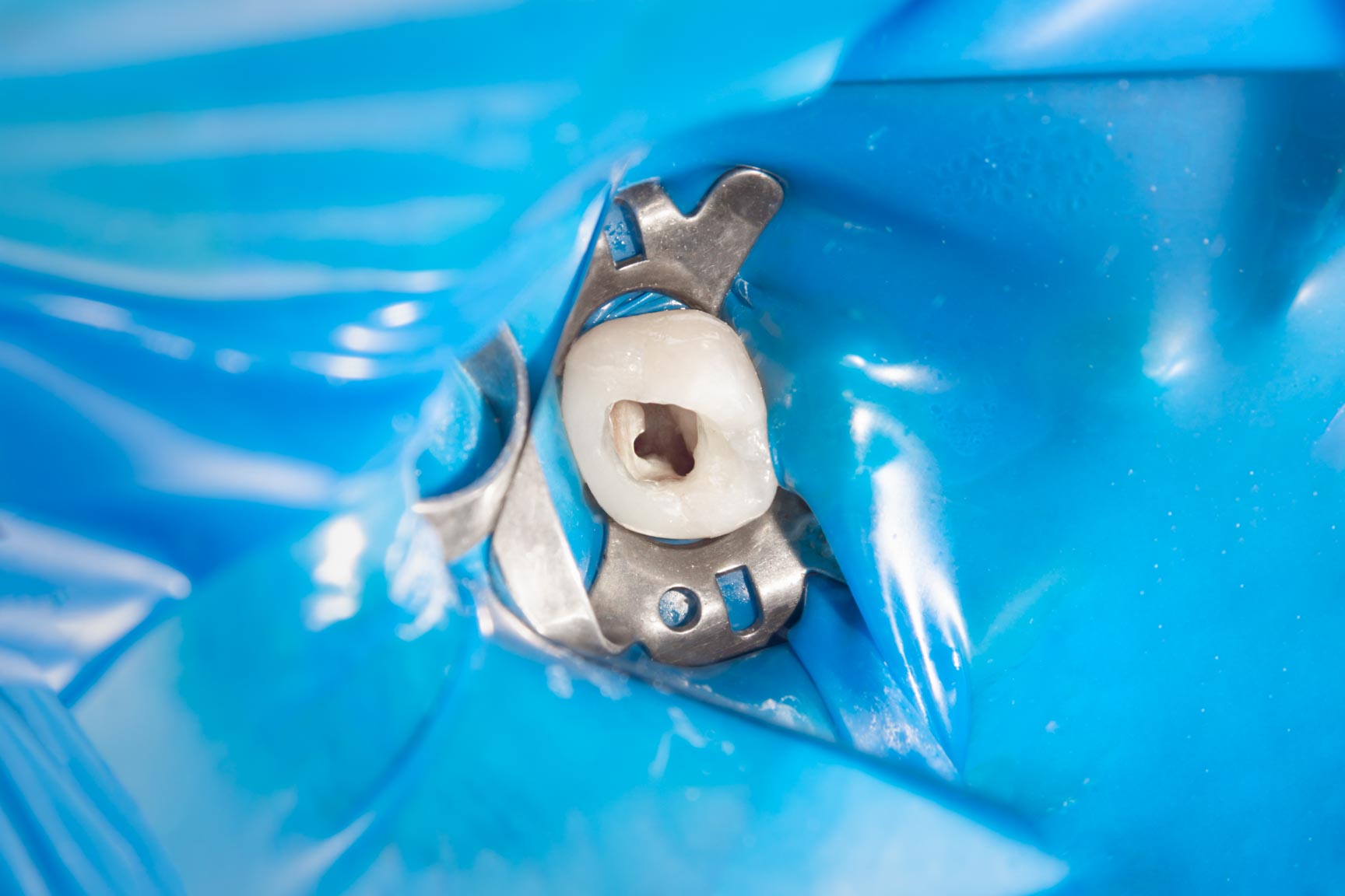 Root canal treatment